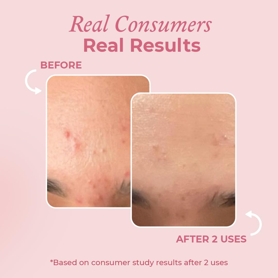 Pink Foundry Acne Spot Corrector – Fast-Acting Overnight Pimple Treatment for All Skin Types