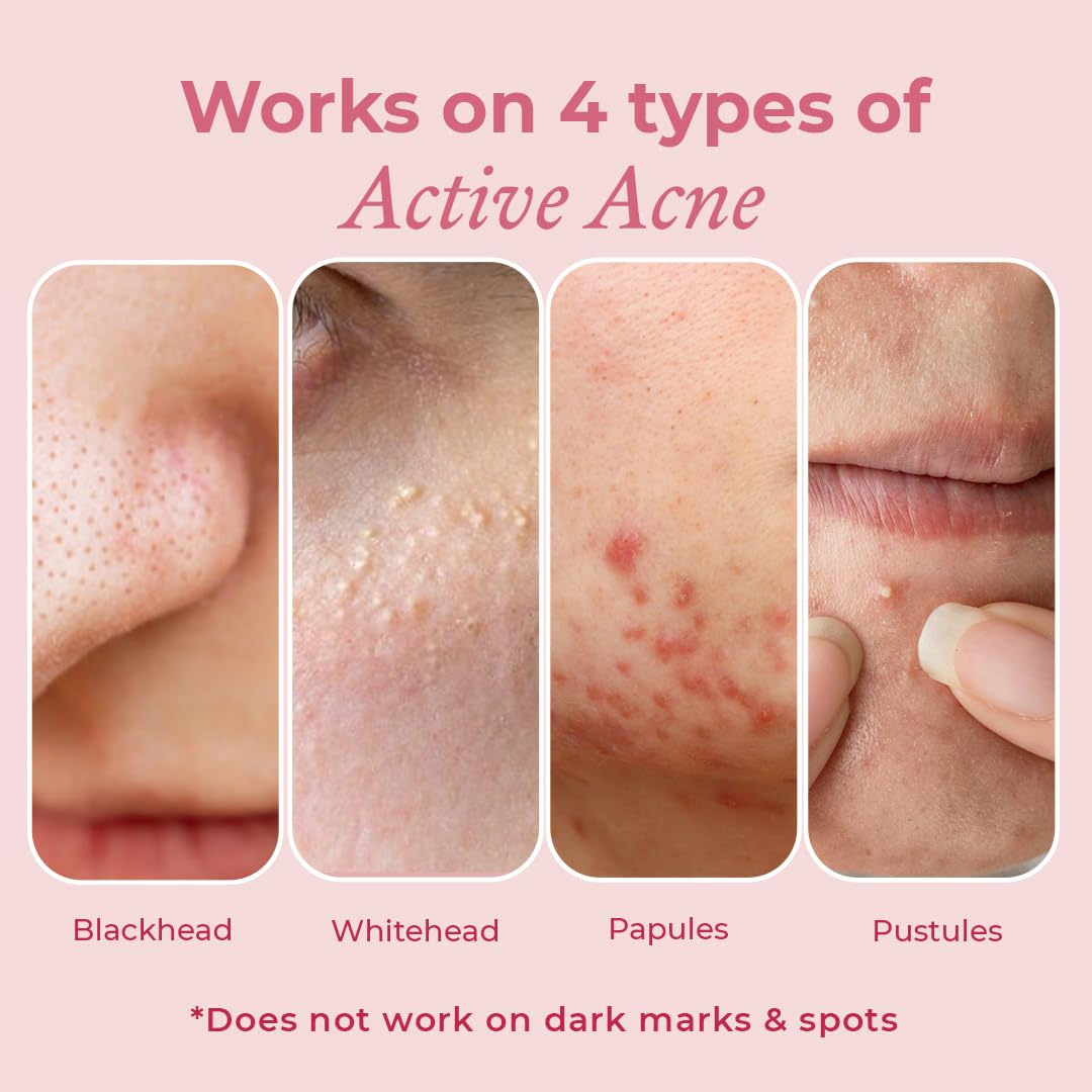 Pink Foundry Acne Spot Corrector – Fast-Acting Overnight Pimple Treatment for All Skin Types