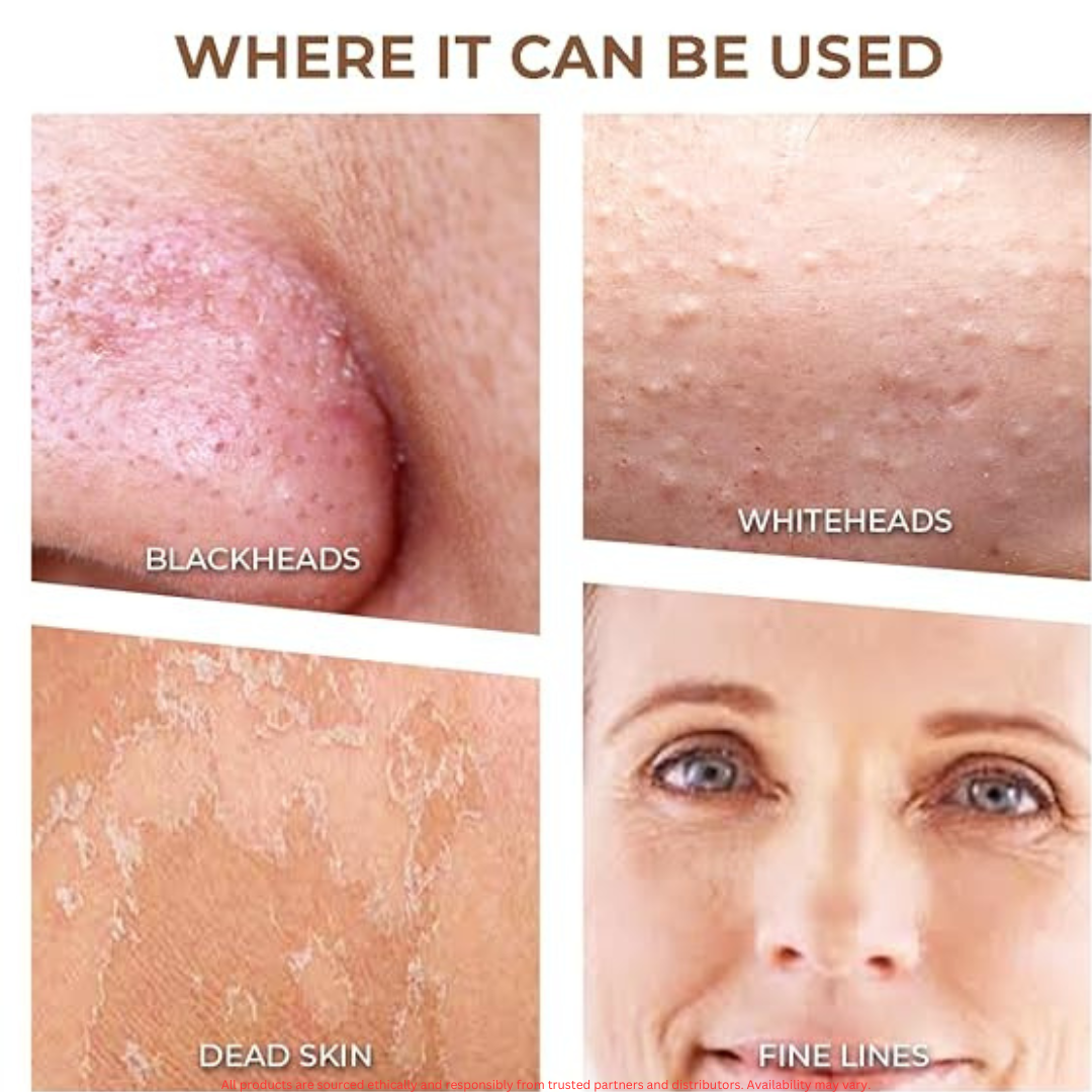 Winston Rechargeable Blackhead Remover – Deep Pore Cleansing & Gentle Suction