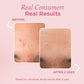 Pink Foundry Acne Spot Corrector – Fast-Acting Overnight Pimple Treatment for All Skin Types