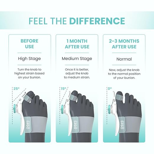 UltraCare PRO ERGO Bunion Corrector – Adjustable & Comfortable Toe Alignment